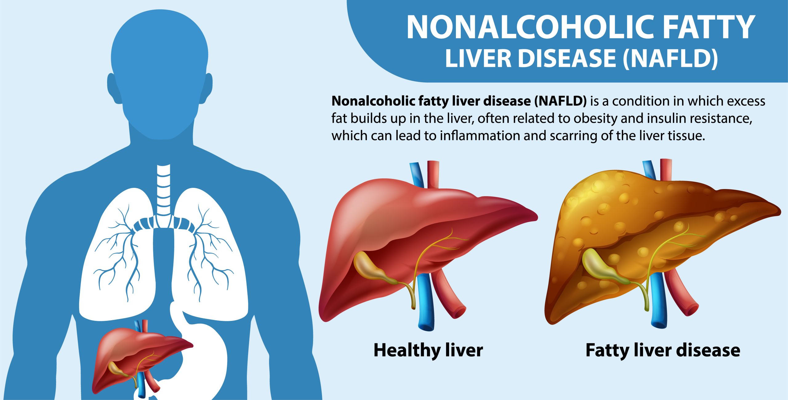 Nonalcoholic Fatty Liver Disease NAFLD